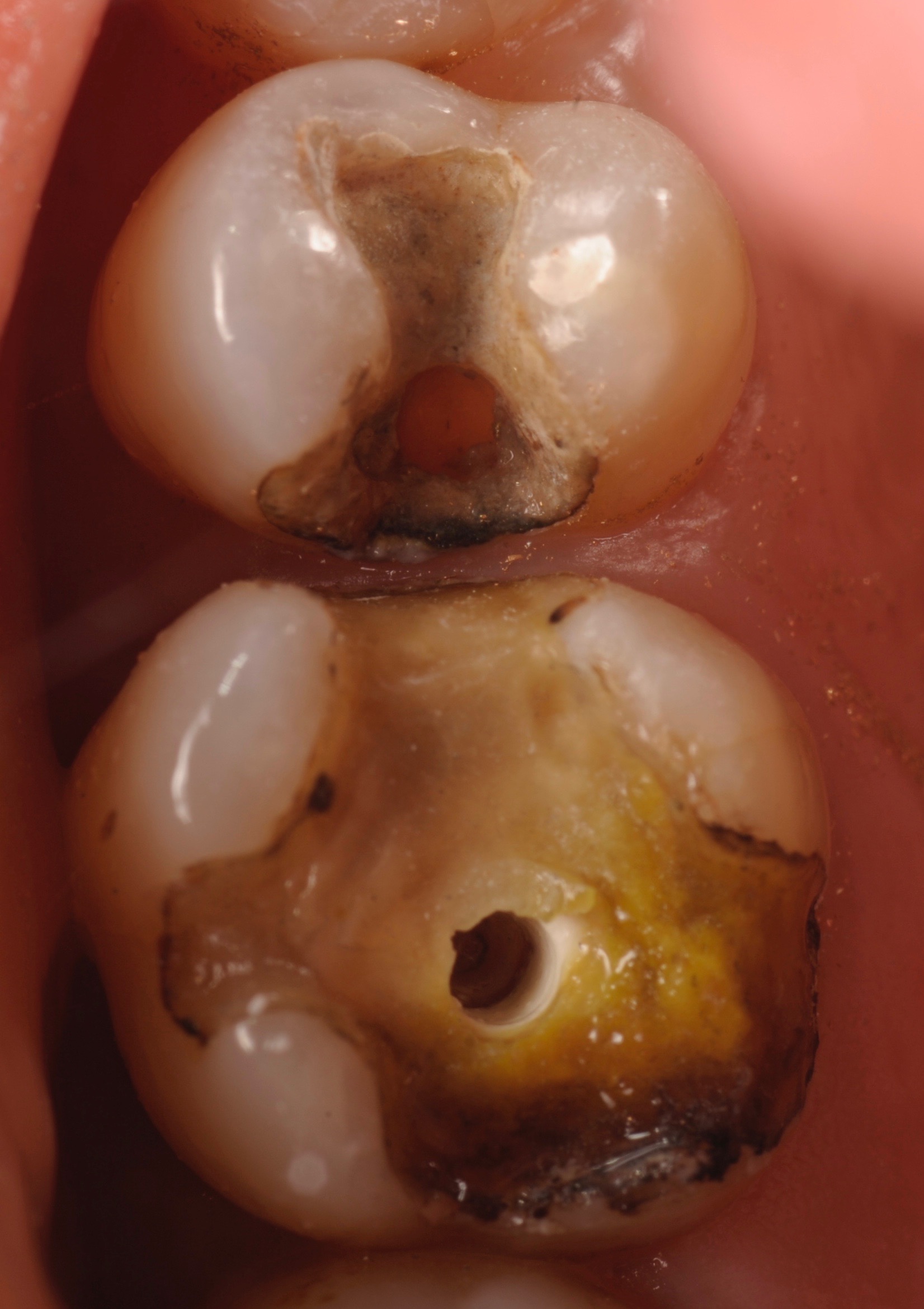 銀歯をはずしてみると、２次虫歯。 | 歯医者のブログ・デンタル 